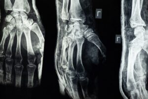 scans of an injured hand