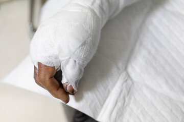 A close-up of a hand wrapped in white bandages, resting on a quilted surface. The fingers are partially exposed, hinting at medical care for one of the types burn injuries.